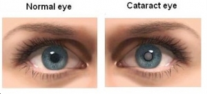 Cataract Treatment In Mumbai