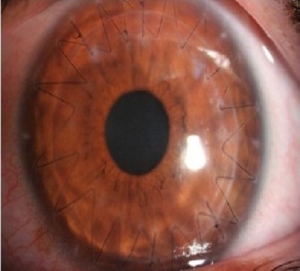 DALK (Deep anterior lamellar Keratoplasty) 
