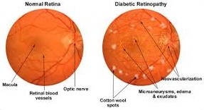 Diabetic Retinopathy Diabetic Retinopathy