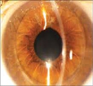 DSEK (Descemets stripping endothelial keratoplasty) 