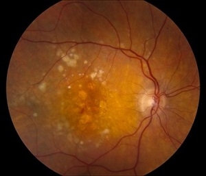 Early stage wet AMD Early stage wet AMD