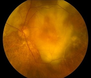 End stage wet AMD with scarring End stage wet AMD with scarring