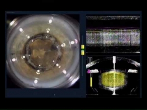 Refractive Laser-Assisted Cataract Surgery in Mumbai