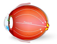 Glaucoma Treatment in mumbai