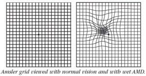 Amsler grid Amsler grid
