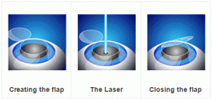 Refractive Surgery or Lasik Treatment Refractive Surgery or Lasik Treatment
