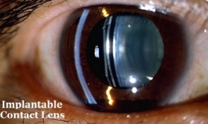 ICL (implantable collamer lenses) ICL (implantable collamer lenses)