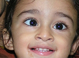 Paediatric Opthalmology & Squint Treatment