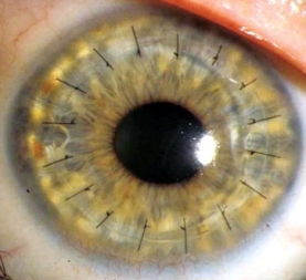 Different Techniques of Keratoplasty Penetrating keratoplasty (Corneal Transplantation):