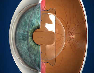 Phakic Lens (ICL) Surgery?