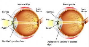 Presbyopic Lasik Presbyopic Lasik