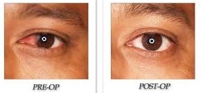 Pterygium