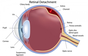 Retinal Tear / Detachment Retinal Tear / Detachment