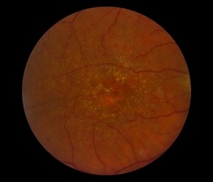 Dry AMD can be a precursor to wet AMD Dry AMD can be a precursor to wet AMD