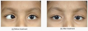Surgical management of squint